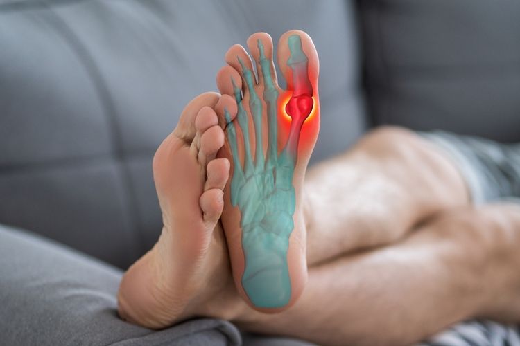 Serangan asam urat paling sering bermula di area jempol kaki. Tanda-tanda asam urat di jempol kaki yaitu nyeri sendi hingga sulit menggerakkan ibu jari.