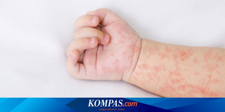 Kasus Campak di Jember Terus Naik, Dinkes Sebut Cakupan Imunisasi Masih Rendah