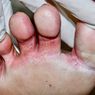 Kaki Atlet (Tinea Pedis)