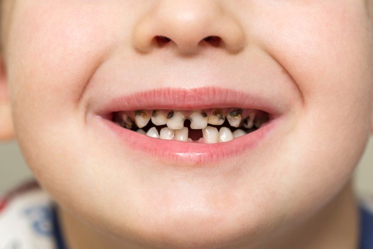 Ilustrasi apakah karies gigi pada anak dapat tumbuh kembali?