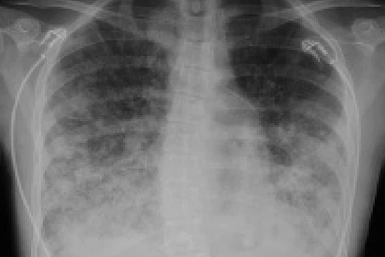 Dari hasil pengamatan dokter, paru-paru Dakota kemungkinan besar mengalami EVALI yang disebabkan 'vaping'.
