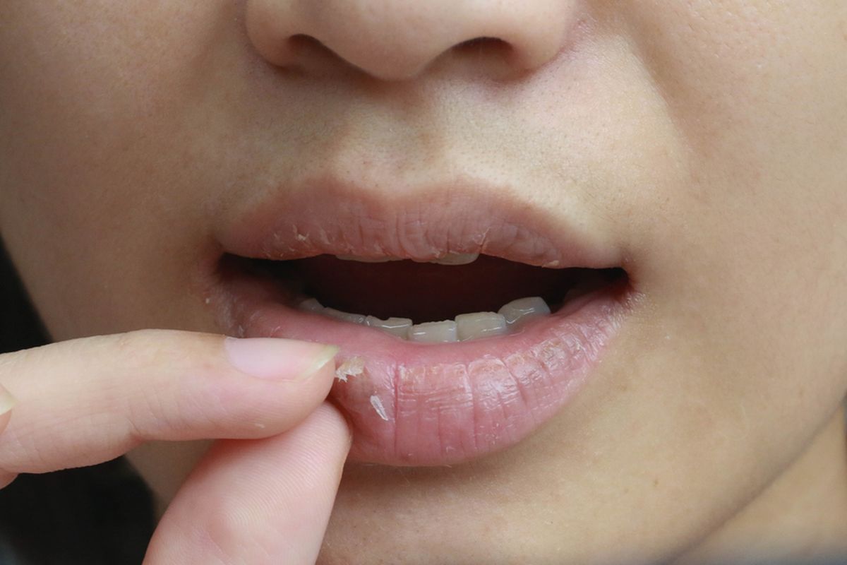 Menghindari kebiasaan mengelupasi kulit bibir adalah salah satu cara mengatasi bibir pecah-pecah,