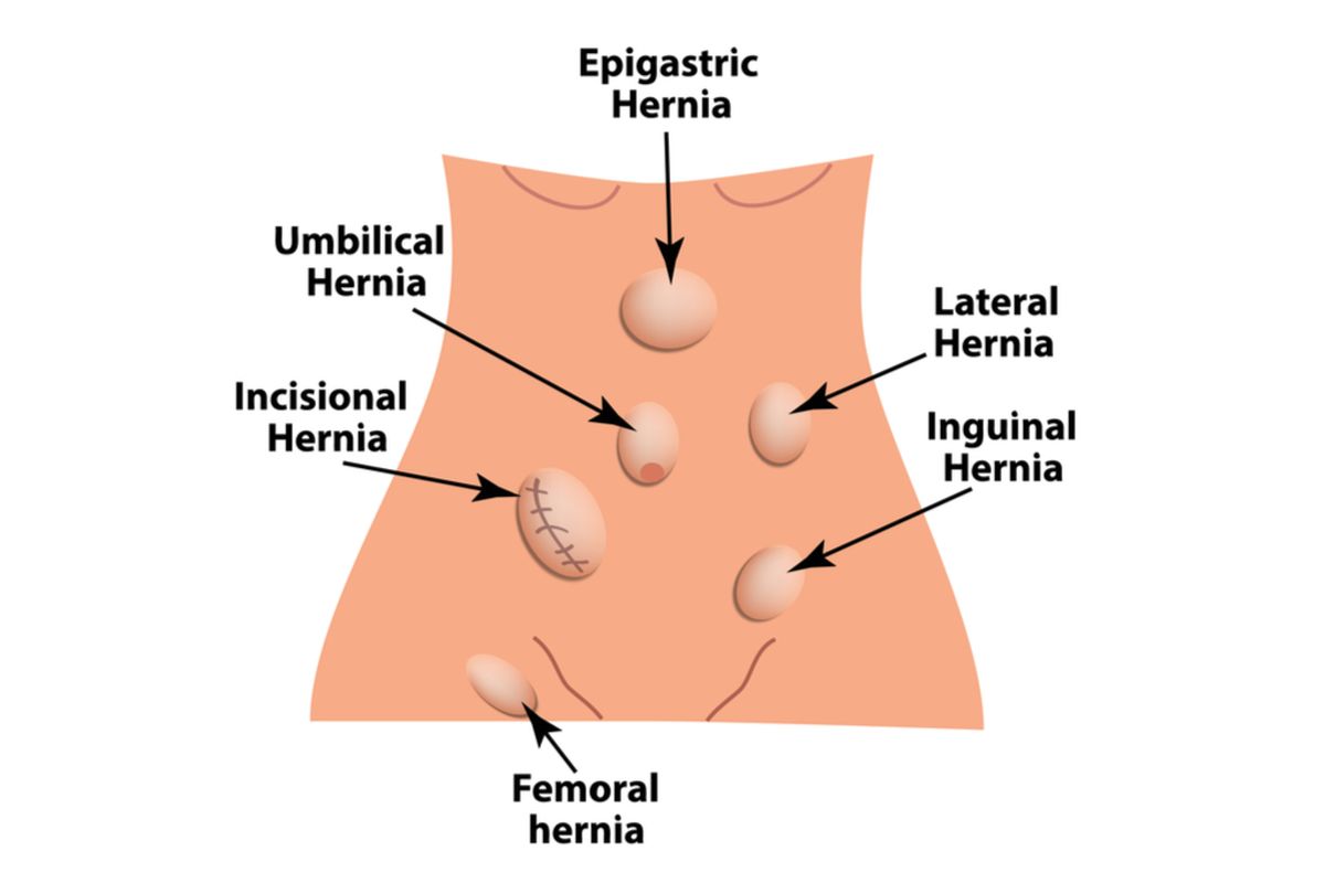 Ilustrasi Hernia