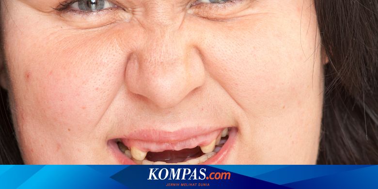 Penyakit Anodontia - Gejala, Penyebab, Pengobatan - Kompas.com