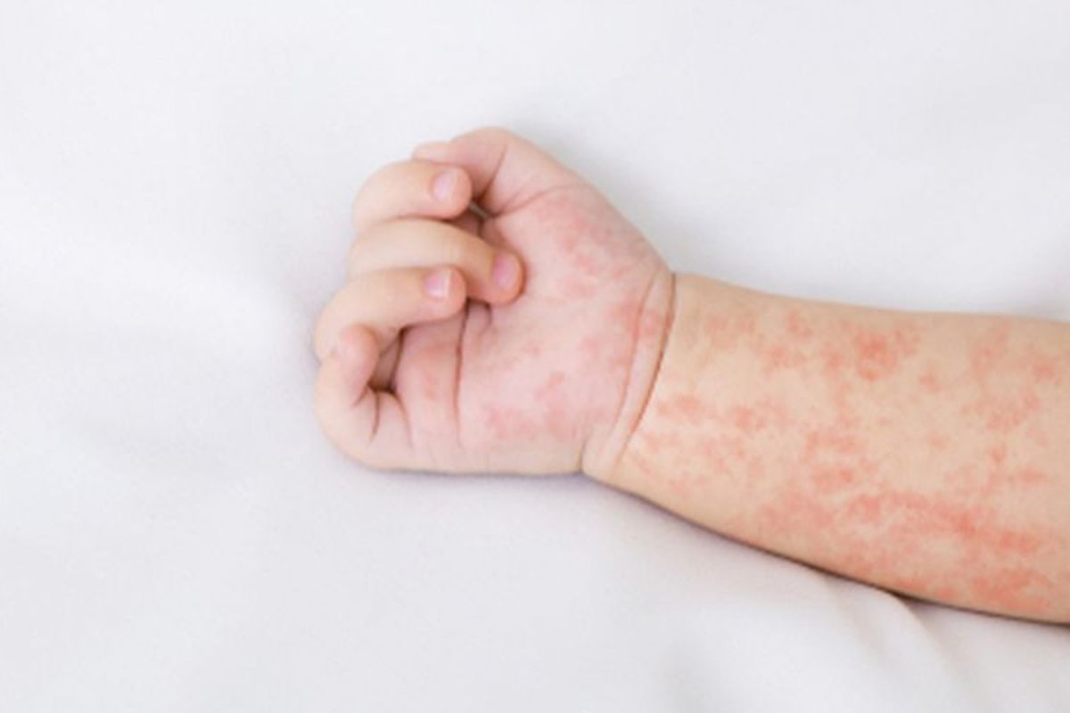 Ilustrasi campak. Kasus campak di Kabupaten Jember, Jawa Timur terus bertambah. (Shutterstock/Prostock-studio)