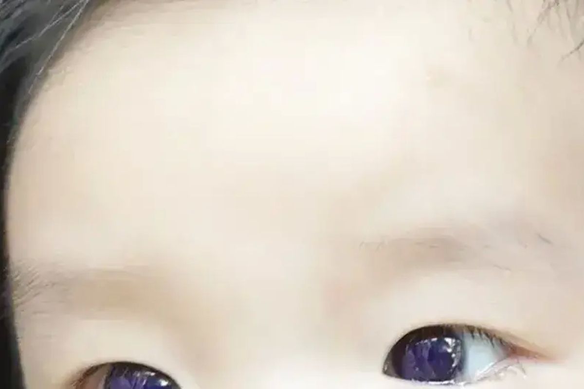 Bola mata seorang bayi berusia enam bulan di Jepang berubah menjadi biru saat menjalani perawatan akibat infeksi virus corona. 