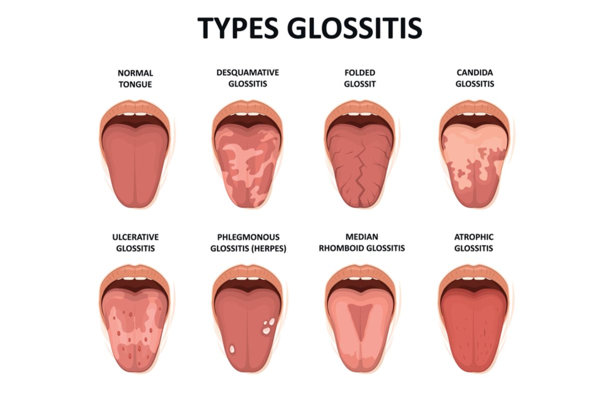 ilustrasi glositis