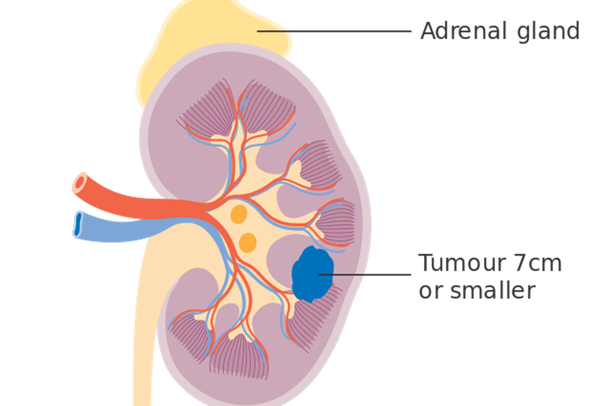 Ilustrasi kanker ginjal. 