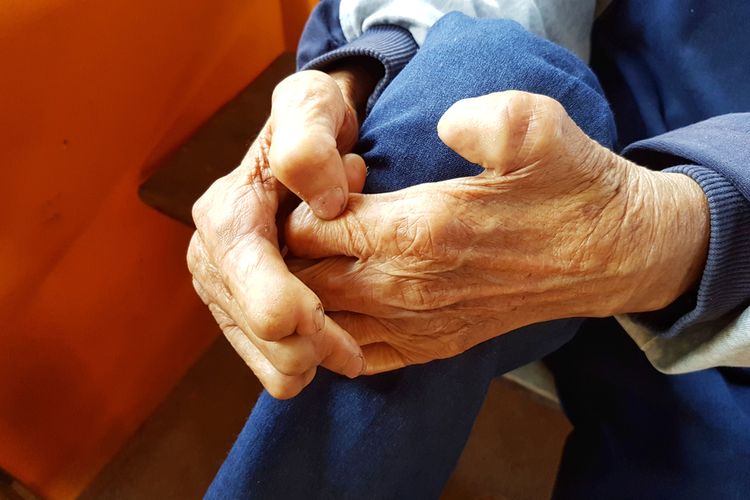 Ilustrasi penyakit kusta. Kusta adalah penyakit menular karena infeksi bakteri Mycobacterium leprae yang menyerang saraf, kulit, mata, atau saluran pernapasan atas. Kenali apa itu kusta, penyebab kusta, sampai ciri-ciri kusta. 