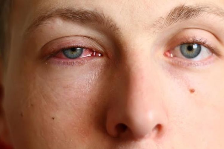 Ilustrasi mata merah. Penyebab konjungtivitis atau mata merah yang umum meliputi alergi, infeksi bakteri, dan infeksi virus.