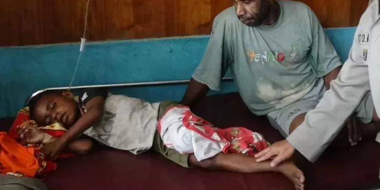 Gizi buruk dan wabah kelaparan terus berulang di Papua. Foto ini diambil di Agats, Kabupaten Asmat, tahun 2018, saat gizi buruk menyerang belasan anak.