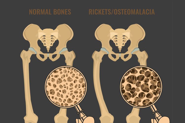 Ilustrasi osteomalasia