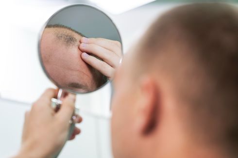 7 Cara Menumbuhkan Rambut Botak di Usia Muda, Anti Ribet!