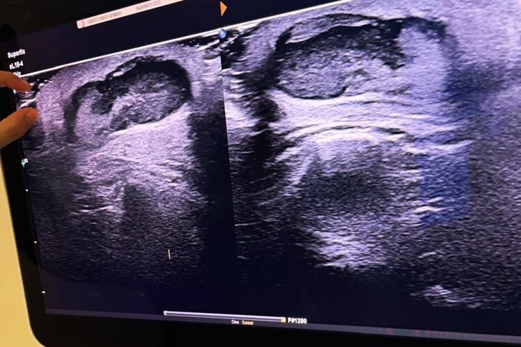 Tangkapan layar akun Instagram Raffi Ahmad @raffinagita1717. Raffi Ahmad mengungkap dirinya menjalani operasi akibat benjolan di bahu yang diduga lipoma, kondisi yang umumnya jinak tetapi tetap perlu diperiksa jika terus membesar atau berubah.