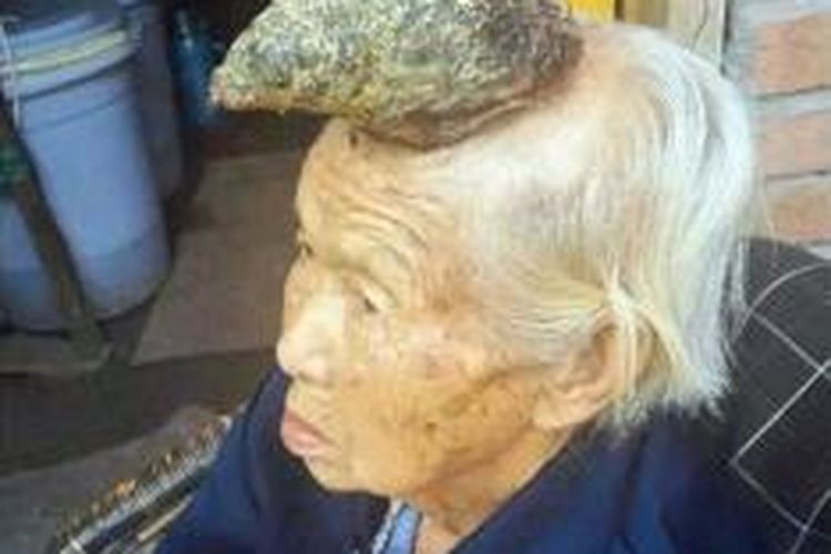 Sebuah 'tanduk' tumbuh di kepala Liang Xiuzhen (87) asal Tiongkok.