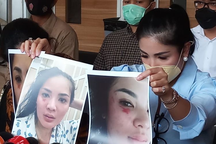 Penyanyi Nindy Ayunda menunjukkan foto-foto lebam pada wajahnya akibat kekerasan dari suaminya, Askara Parasady, di kantor Komnas Perempuan, Jakarta, Selasa (16/2/2021).