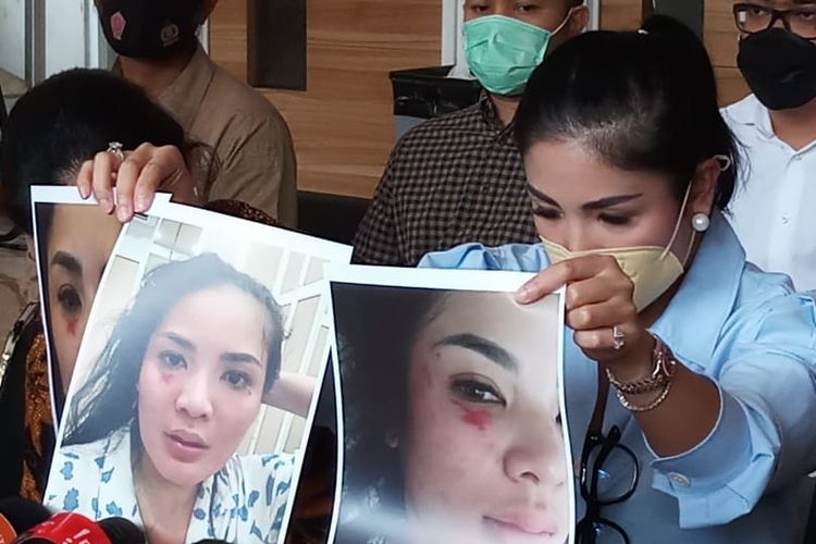 Nindy menunjukkan sejumlah foto yang memperlihatkan luka lebam akibat tindak kekerasan yang dilakukan sang suami.