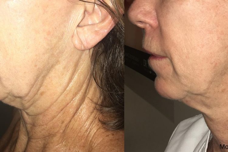 Mengencangkan kulit bisa menjadi cara ampuh untuk mencegah penuaan dini