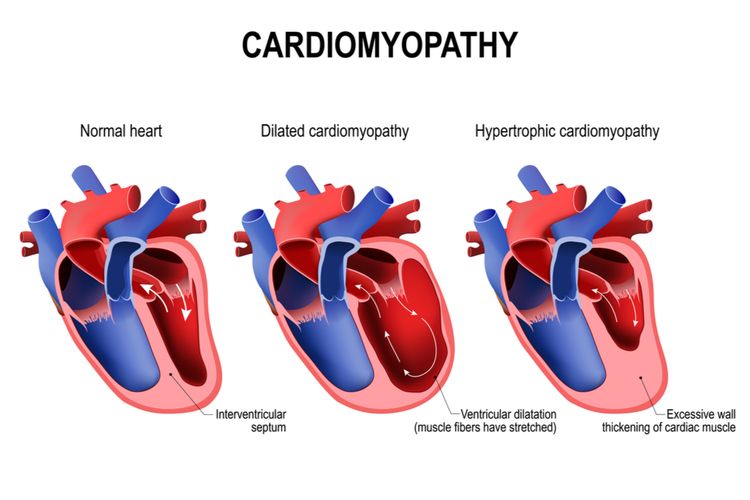 Ilustrasi Kardiomiopati