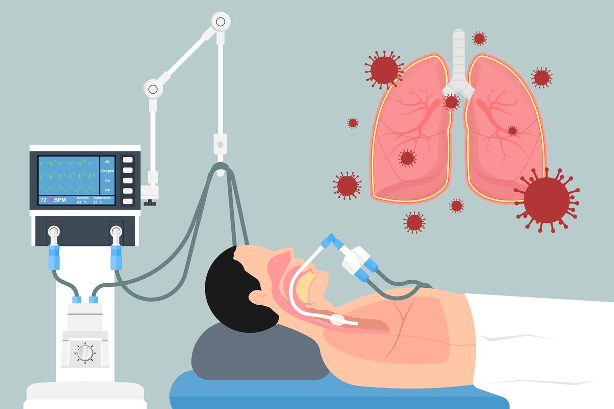 Ilustrasi acute respiratory distress syndrome (ARDS) 