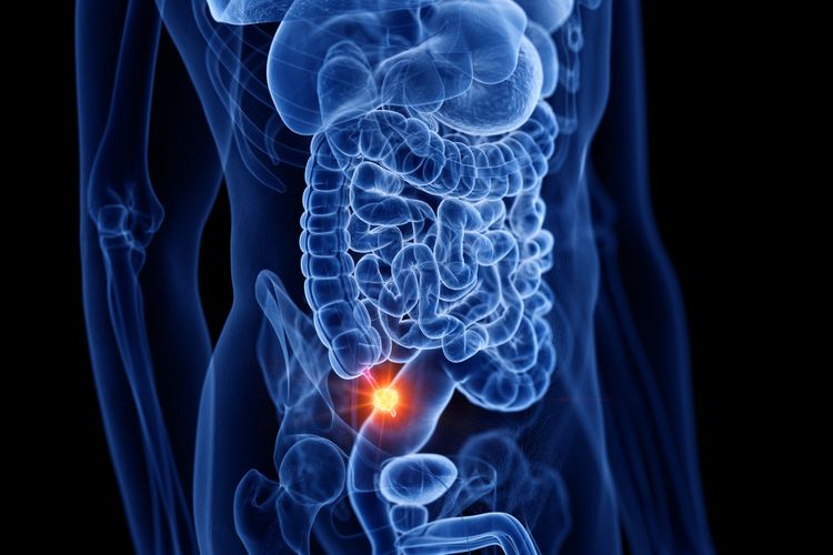 Kemenkes Buka Suara soal Viral Diagnosis Usus Buntu RI vs Malaysia