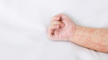 Campak Bisa Sebabkan Pneumonia hingga Radang Otak, Jangan Anggap Penyakit Ringan