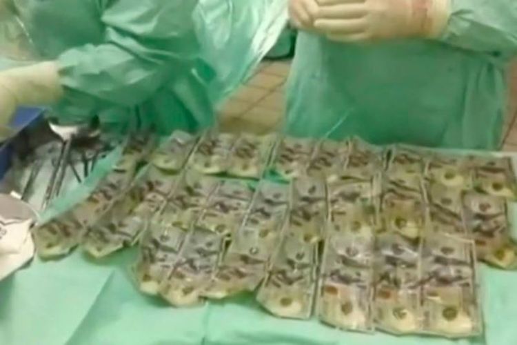 Inilah puluhan lembar uang pecahan 100 dolar AS yang dikeluarkan dari perut seorang perempuan asal Kolombia.