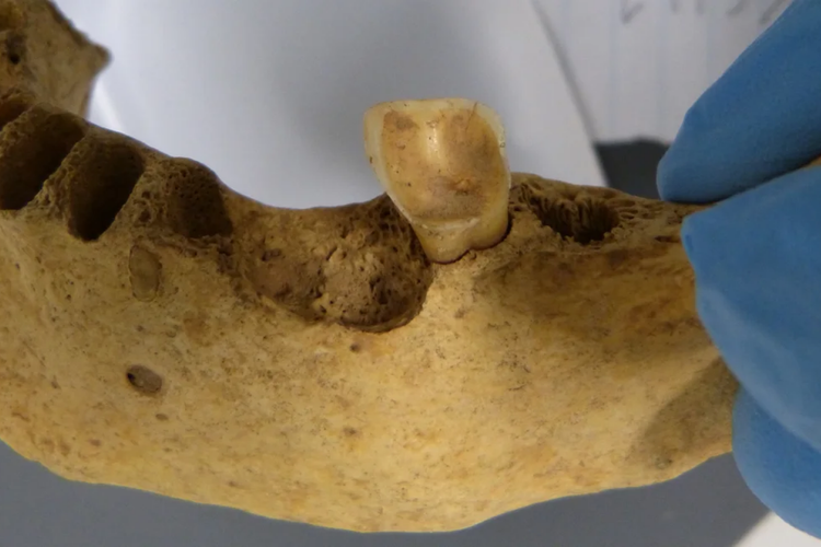 Bakteri penyebab gigi berlubang ditemukan pada gigi berusia 4000 tahun 
