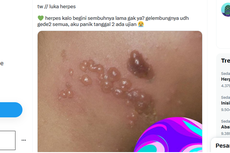 Berapa Lama Herpes Bisa Sembuh? Ini Kata Dokter