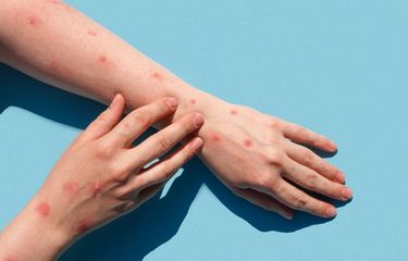 Demi terhindar dari wabah cacar monyet, ada baiknya kita untuk mengetahui mitos keliru tentang monkeypox yang sudah dibantah para ahli kesehatan. 