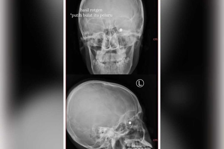 Siswa SMA di Garut Tertembak Airgun, Kecurigaan Dokter Ungkap Proyektil Logam di Bola Mata