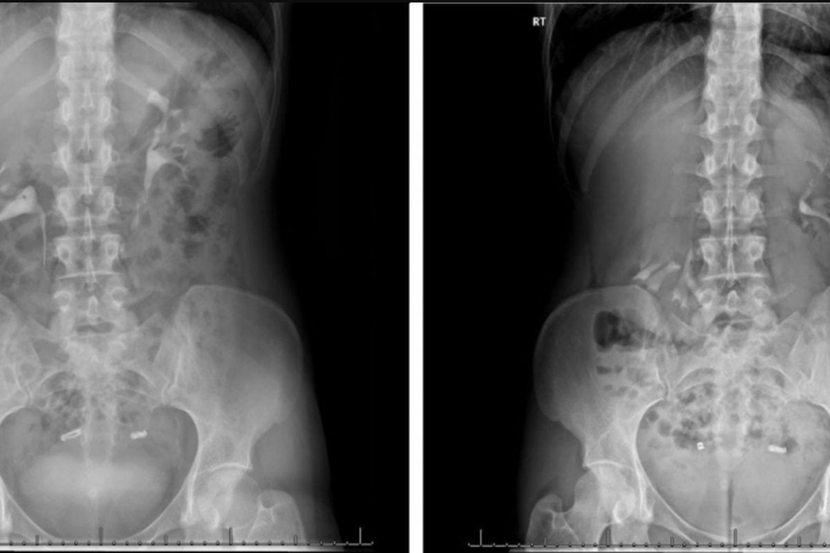 Hasil CT Scan seorang perempuan yang ginjalnya turun sampai panggul. Hasil CT Scan kiri, diambil saat perempuan itu berbaring dan terlihat letak ginjalnya normal. Hasil CT Scan kanan, diambil saat berdiri da menunjukkan ginjal kanannya (terlihat di sebelah kiri dalam hasil CT Scan) jatuh ke panggul. Ginjal kiri (terlihat di sebelah kanan dalam pemindaian) berada di bawah tulang rusuk.
