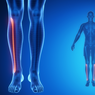 Nyeri Tungkai yang Tak Kunjung Hilang Bisa Jadi Gejala Kanker Tulang
