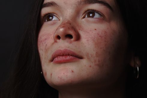 3 Hal Ini Bisa Menjadi Penyebab Rosacea