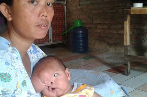 Dinkes Bekasi: Keluarga Bayi Penderita Tumor di Wajah Harus Tahu Regulasi RS