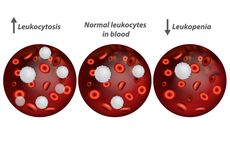 Leukositosis dan Leukimia, Kondisi Jumlah Leukosit di Atas Normal 
