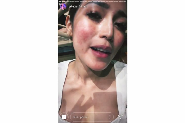 Wajah Jessica Iskandar memerah karena alergi anestesi.