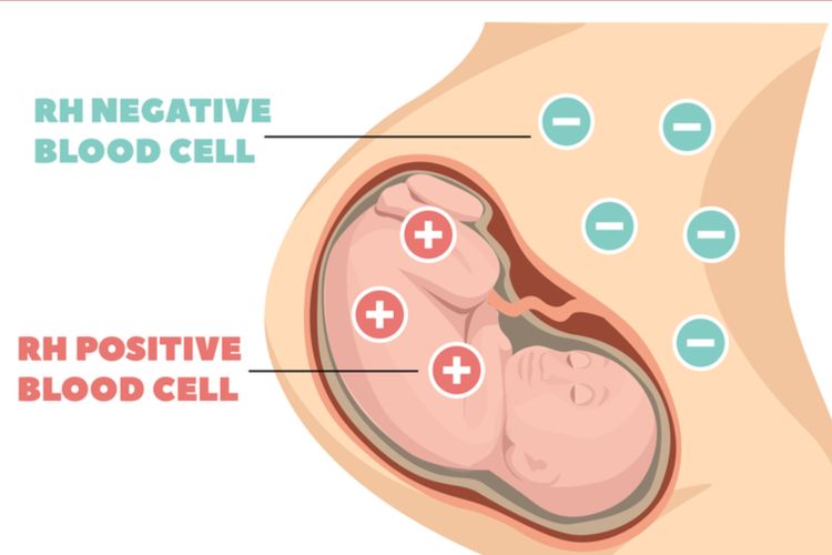 ilustrasi inkompatibel rhesus