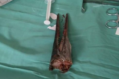Cerita Dokter Saat Keluarkan Moncong Ikan Marlin dari Leher Idul: Dalamnya 15 Cm