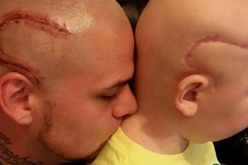 Ayah Bikin Tato Bergambar Luka Operasi di Kepala demi Dukung Sang Anak