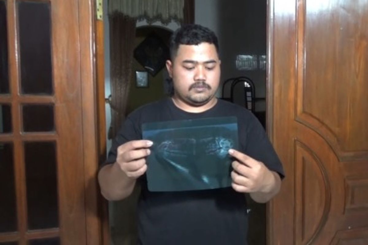 Davin Ahmad Sofyan memperlihatkan foto rongen gigi geraham bagian kiri bawah istrinya yang dicabut. Pasca pencabutan gigi tersebut istrinya mengalami infeksi hingga meninggal. Davin mengaku akan membawa ke ranah hukum adanya dugaan kesalahan penanganan cabut gigi bungsu istrinya.