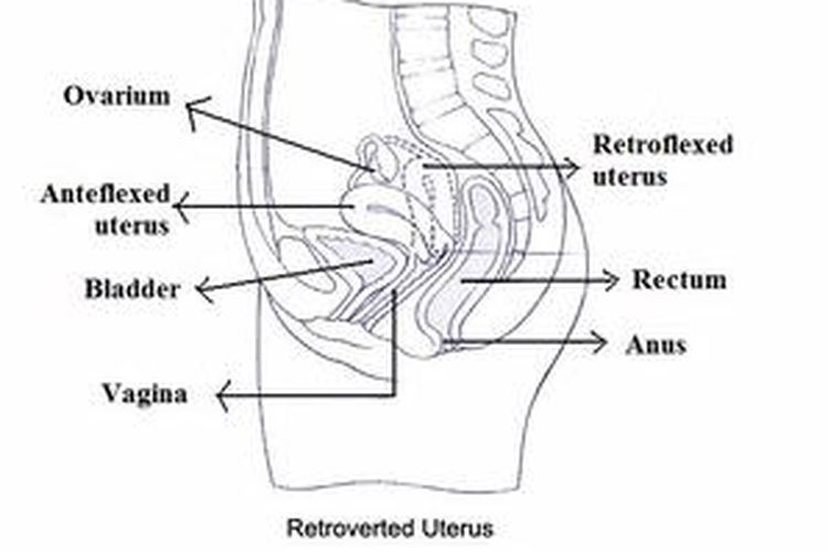 Rahim Menghadap Ke Belakang Bikin Sulit Hamil