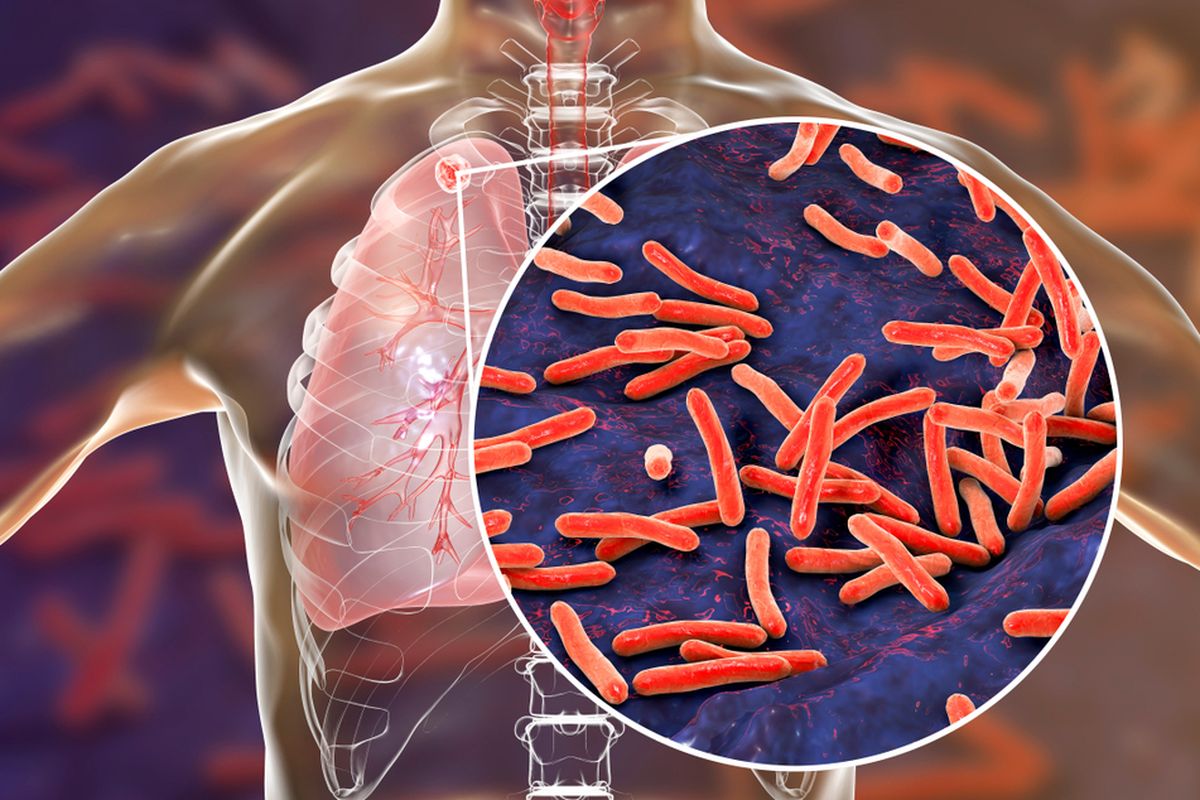 Ilustrasi TBC pada paru-paru. Penyebab TBC adalah bakteri Mycobacterium tuberculosis yang menyebar melalui udara. TBC perlu diwaspadai karena penyakit menular mematikan di dunia.