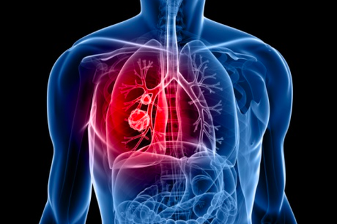 10 Tanda-tanda Kanker Paru-paru Stadium 4 yang Harus Diwaspadai
