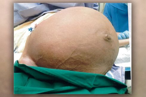 Perempuan Ini Kesulitan Bernapas Akibat Tumor Seberat 33 Kg di Rahim