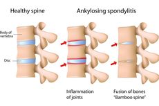 Ankylosing Spondylitis 
