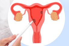 7 Faktor Risiko Kanker Endometrium yang Perlu Anda Ketahui