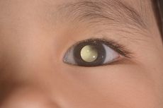 Kenali Apa itu Retinoblastoma, Kanker Mata yang Kerap Menyerang Anak