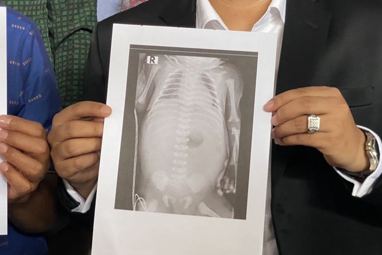 Foto rontgen atau x-ray anak Evayanti, HNM, yang menunjukkan kebocoran pada usus.