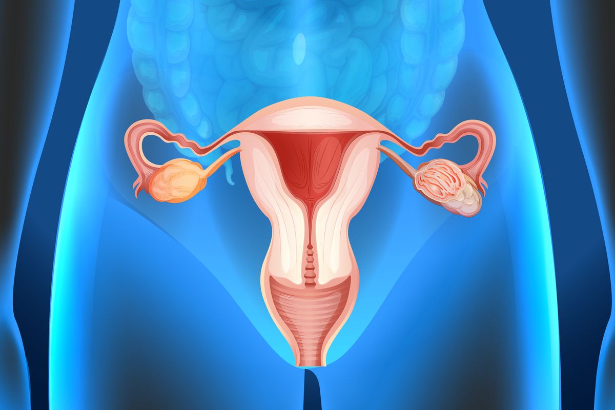 Ilustrasi kista ovarium